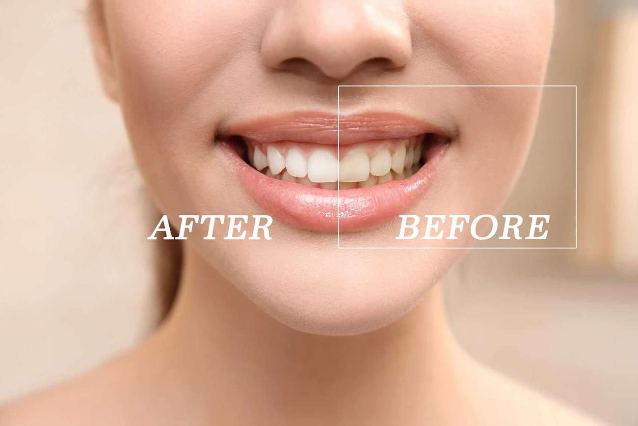 How Can You Maintain a Consistent Smile Shade with Crowns Oxford?