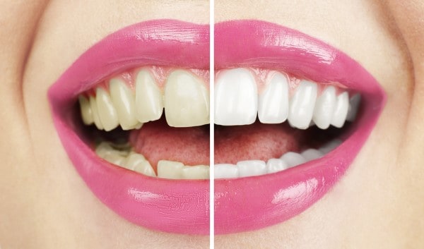 What Makes Ultima White Teeth Whitening Different Oxford