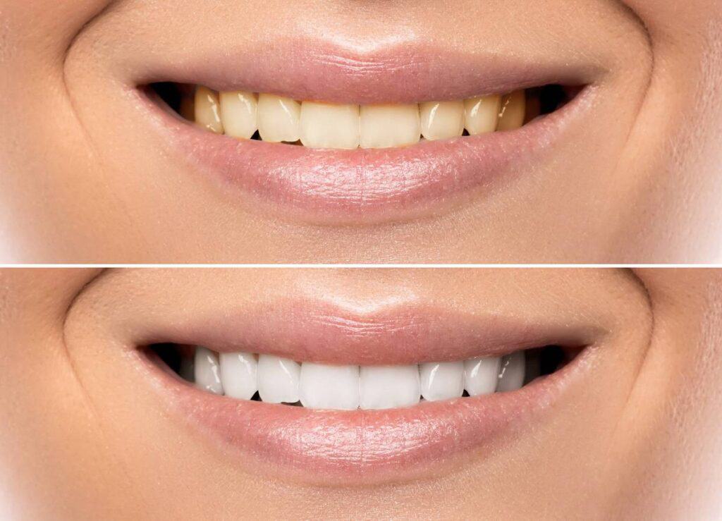 How Can You Protect Your White Smile as a Coffee Lover Oxford?