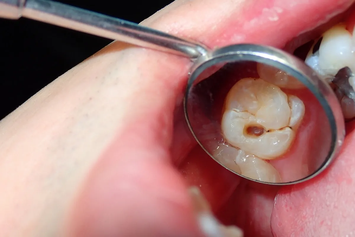Why Do Teeth Crack? Common Causes to Know Oxford