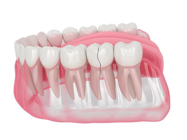 How Can You Manage Pain and Discomfort After a Root Canal Oxford?
