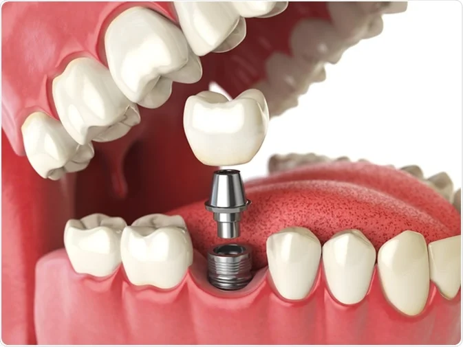 How Do I Decide Which Tooth Replacement Is Right for Me Oxford?