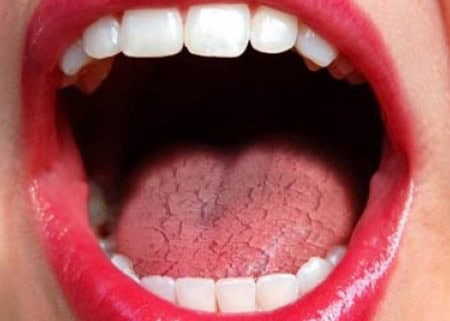 Common Causes of Dry Mouth (Xerostomia) Oxford