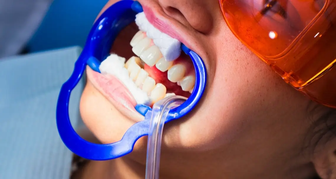 Which Teeth Whitening Method Lasts Longer Oxford?
