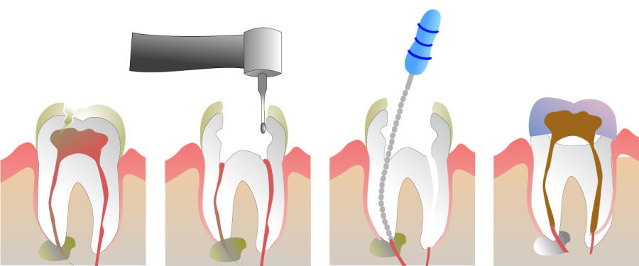 How Do You Properly Care for Your Teeth After a Root Canal Oxford