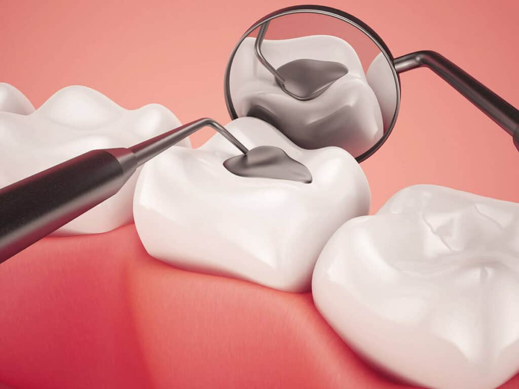 How Can You Prevent Tooth Decay Effectively Oxford