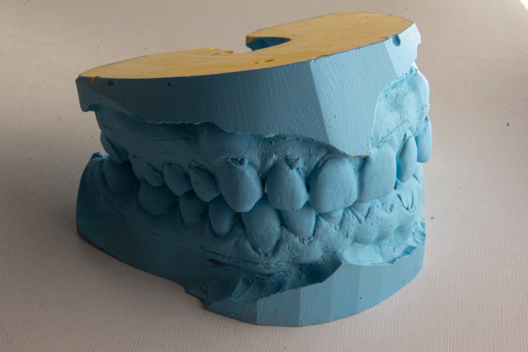How Do Dental Implants Improve Jawbone Health and Oral Function Oxford?