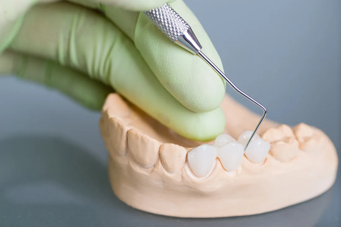 What Are the Different Types of Dental Crowns Available Oxford?