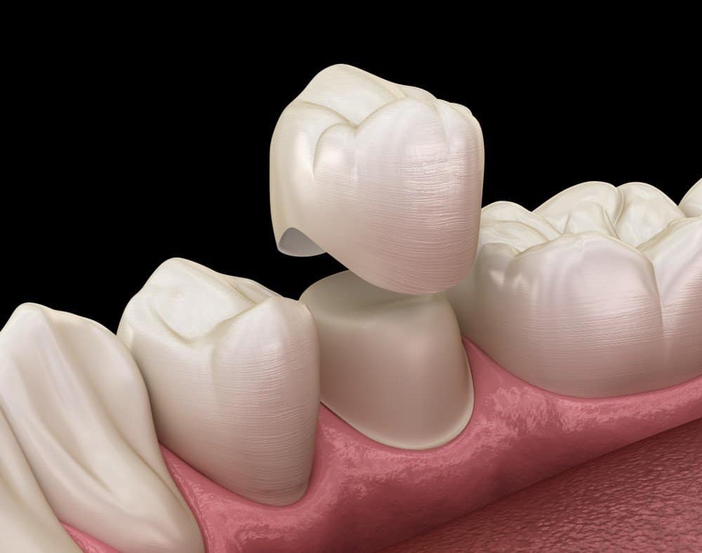 How Can You Prevent Common Dental Crown Problems Oxford?
