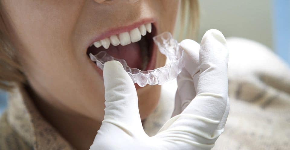 How Much Does Laser Teeth Whitening Cost Compared to Overnight Trays Oxford?